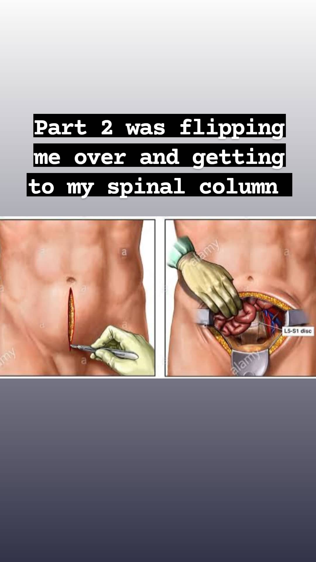 Fundraiser by Leecie Munster : Help Leecie through her 3rd spinal